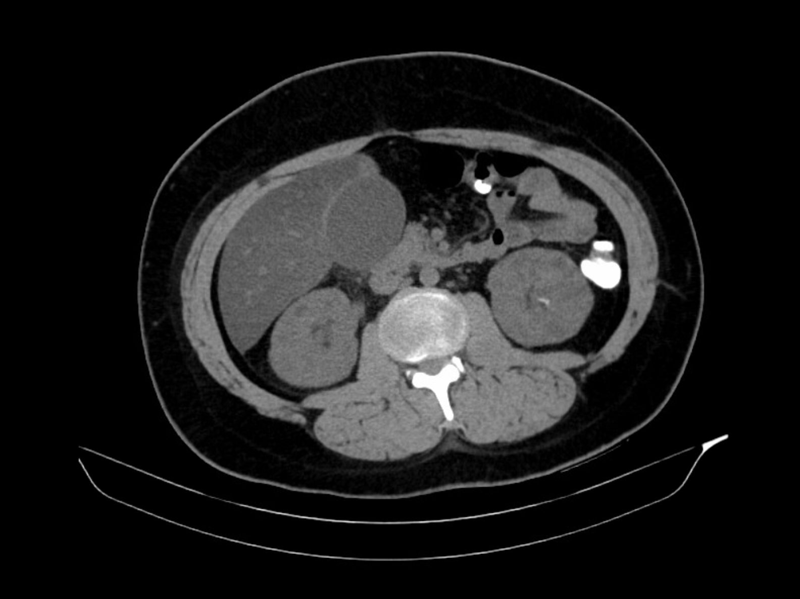 Gallbladder Hematoma Fig 1.png