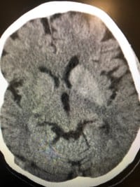 Hyperglycemia - Choreiform Motion Fig 1.jpeg