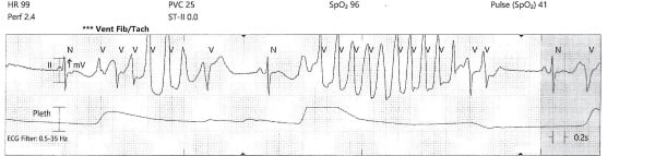 Torsades -1 - polymorphic-premature-ventricular.jpeg