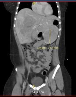 Oral Contraceptives - Coronal view of another bleeding mass.jpg