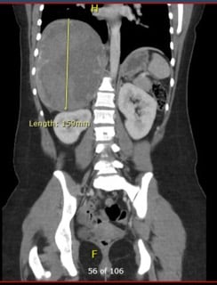 Oral Contraceptives - Coronal view of bleeding mass.jpg