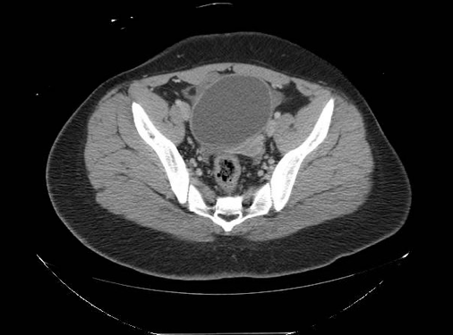Ovarian Torsion Fig 1.png