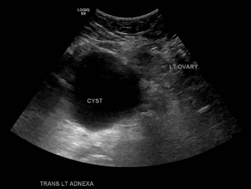Ovarian Torsion Fig 2.png