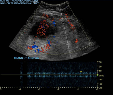 Ovarian Torsion Fig 3.png