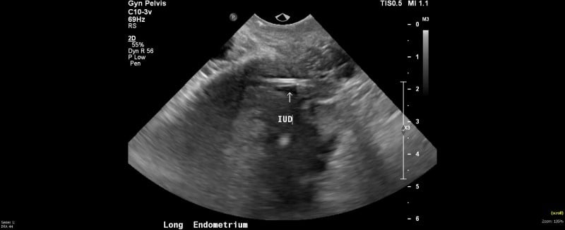 Pelvic US IUD Malpositioned Image 1.jpg