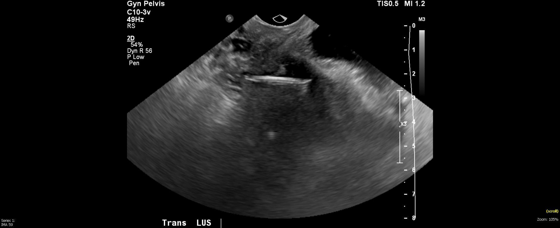 Pelvic US IUD Malpositioned Image 2.jpg