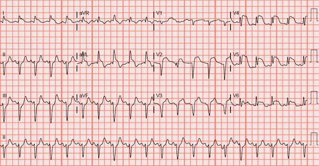 SCAD - EKG.jpeg