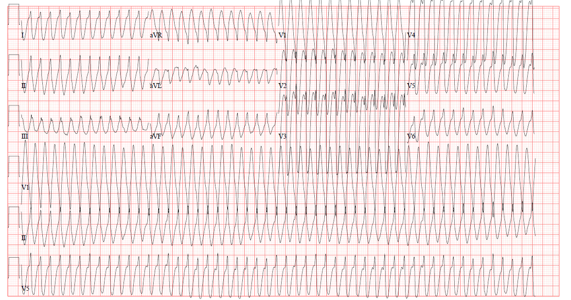 ECG Challenge 49-4 - WCT ECG.png