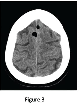 PneumoFigure3.jpg