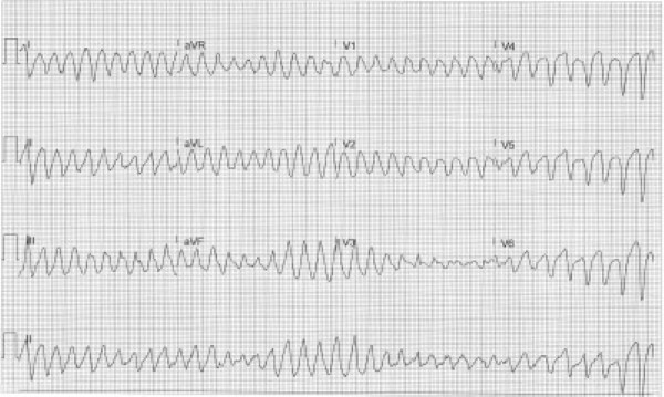 49-5 ECG Challenge Torsades image.jpg