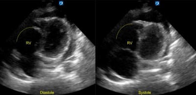 Ultrasound Effusion.jpg