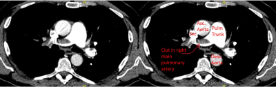 Pulmonary Embolism 4.png