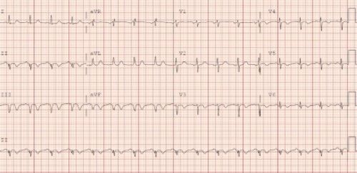 ECG Challeng Q-waves image.JPG