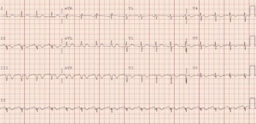 ECG Challeng Q-waves image.JPG