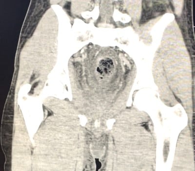 Pelvic Sepsis Figure 2.jpg