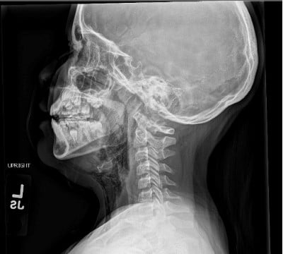 Pneumoparotid Picture 1.jpeg