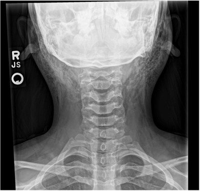 Pneumoparotid Picture 2.jpeg