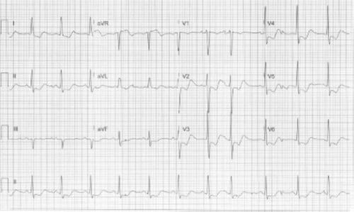 ECG Challenge Hypokalemia.jpg