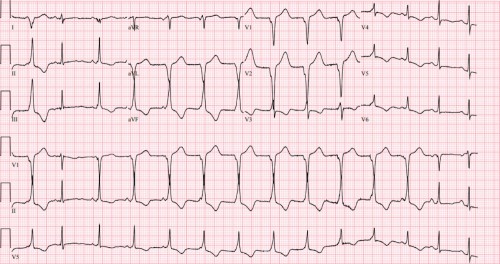 ECG AIVR.jpg