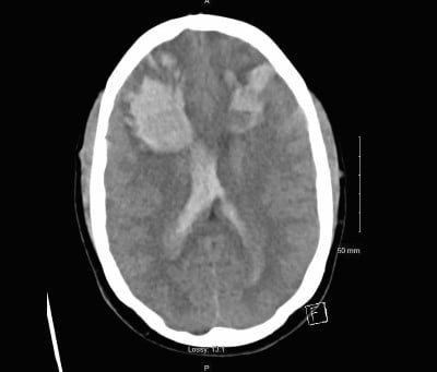 Intracranial Figure 1.jpg