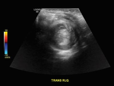 Intussusception Image 2.jpg