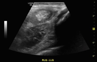 Intussusception Image 3.jpg