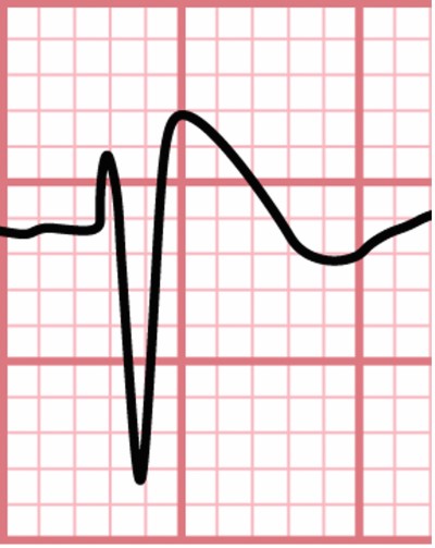 ECG Challenge - Brugada Fig 1.jpg