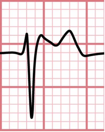 ECG Challenge - Brugada Fig 2.jpg