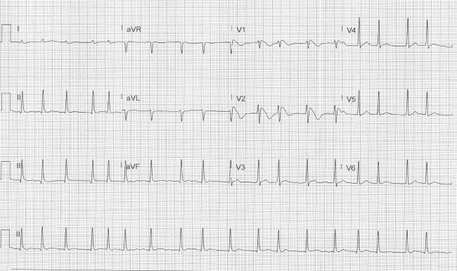 ECG Challenge - Brugada.jpg