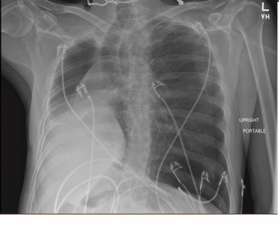 Pneumothorax Image 1.jpg