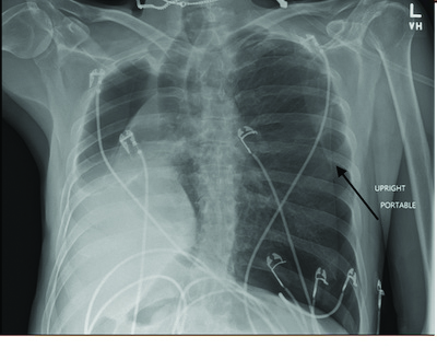Pneumothorax Image 2.jpg