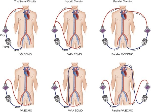 ECMO - Fig 3 circuits.jpg