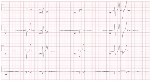 ECG Hyperkalemia.jpg