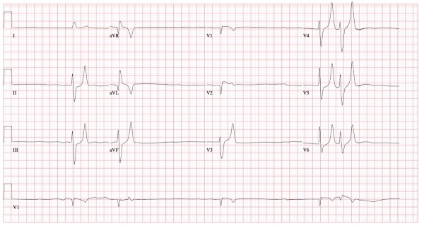 ECG Hyperkalemia.jpg