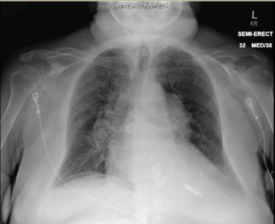 Leadless Pacemaker Image 2.jpg