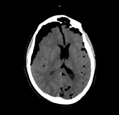 Pneumocephalus Image 1.jpg