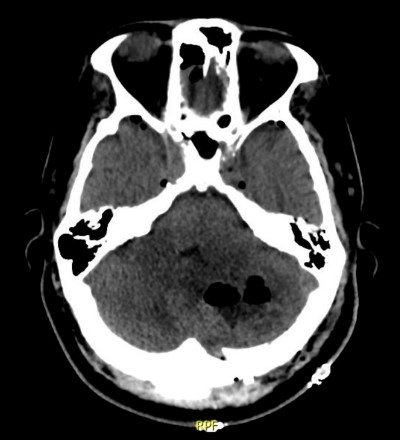 Brain Abscess Image 2.jpg