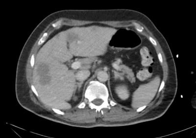 Brain Abscess Image 3.jpg