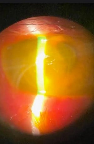 Corneal Keratitis Image 1.jpg