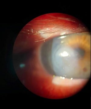 Corneal Keratitis Image 2.jpg