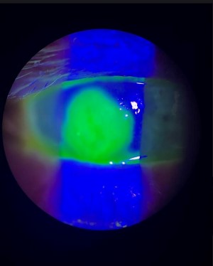 Corneal Keratitis Image 3.jpg