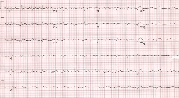 ECG Figure 2 Posterior ECG.jpeg