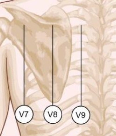 ECG Figure 3 PMI.jpg