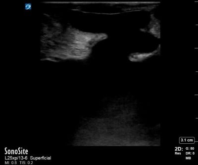 Flood Ultrasound Figure 2.jpg