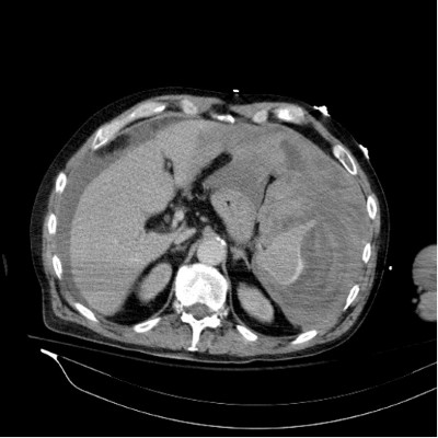 Splenic Figure 1.jpg