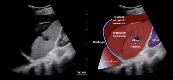 Splenic Figure 4.jpg