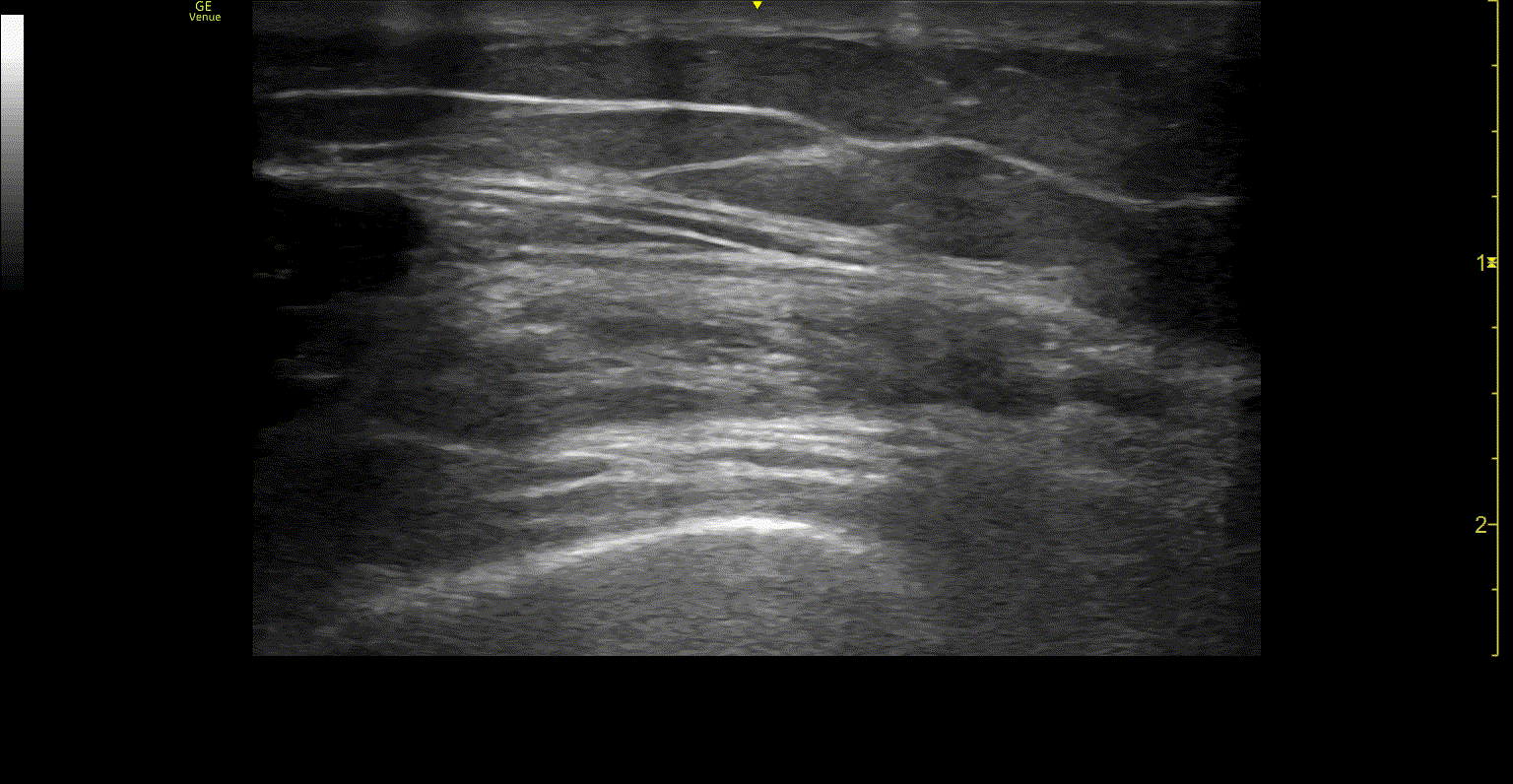 POCUS FTW QTR Video 1.gif