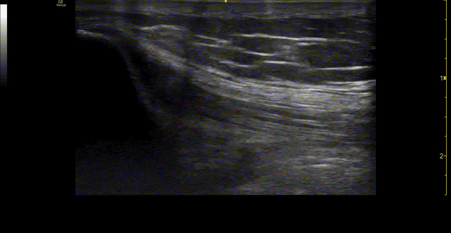 POCUS FTW QTR Video 2.gif