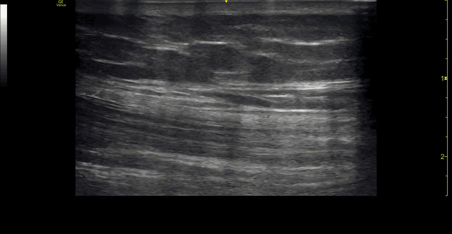 POCUS FTW QTR Video 3.gif