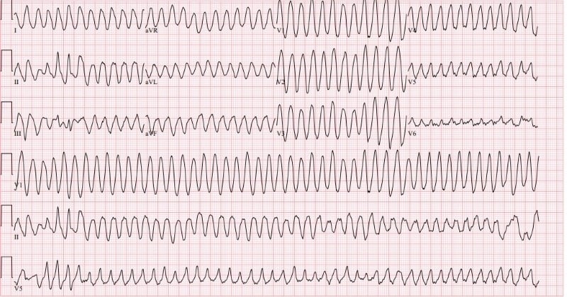 Cardiac Arrest Figure 3.jpg